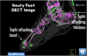 Gouty Foot DECT Image