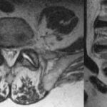 Gout in Spine MRI