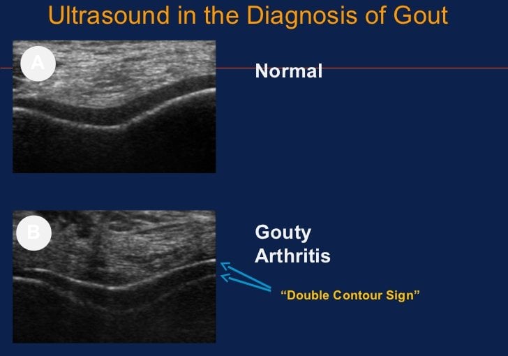 Ultrasound of early chronic gout duration timeline